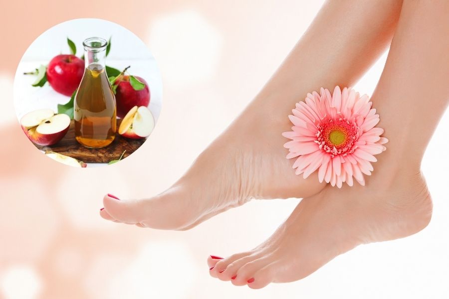 Axit có trong giấm táo có khả năng làm mềm lớp da mắt cá chân bị chai Axit có trong giấm táo có khả năng làm mềm lớp da mắt cá chân bị chai