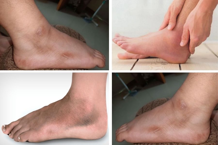 Bị chai mắt cá chân là tình trạng lớp biểu bì trên da phát triển dày hơn bình thường Mắt cá chân bị chai là tình trạng gì?