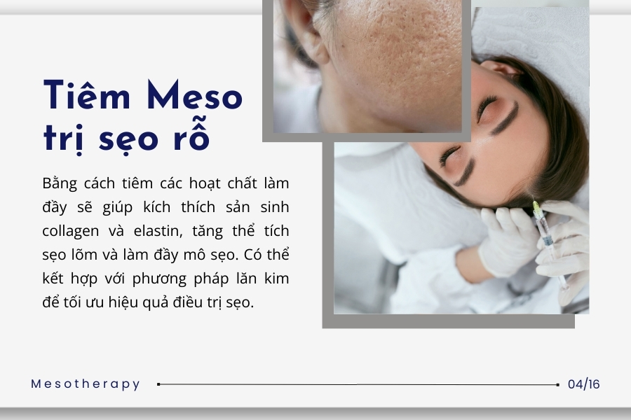Trị sẹo rỗ bằng phương pháp Meso Trị sẹo rỗ bằng phương pháp Meso