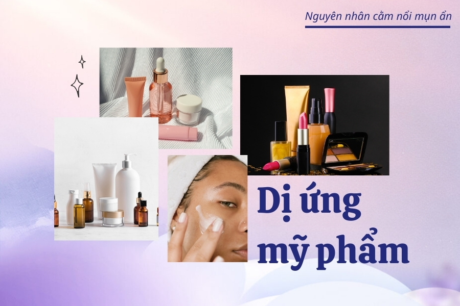 Dị ứng mỹ phẩm khiến mụn ẩn dưới cằm mọc lên “ồ ạt” Dị ứng mỹ phẩm khiến mụn ẩn dưới cằm mọc lên “ồ ạt”