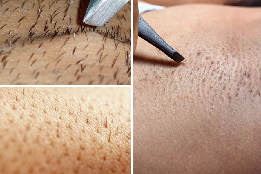 Lông nách mọc đôi là tình trạng 1 lỗ chân lông mọc nhiều lông