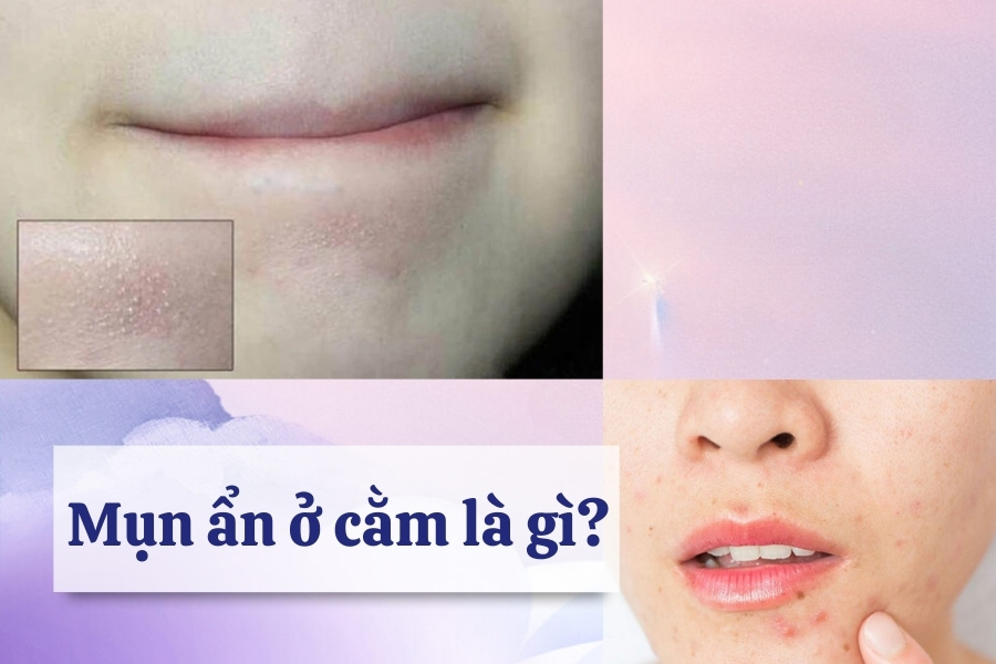 Mụn ẩn ở dưới cằm là những nốt mụn nhỏ, không gây ra tình trạng viêm, sưng Mụn ẩn ở dưới cằm là những nốt mụn nhỏ, không gây ra tình trạng viêm, sưng