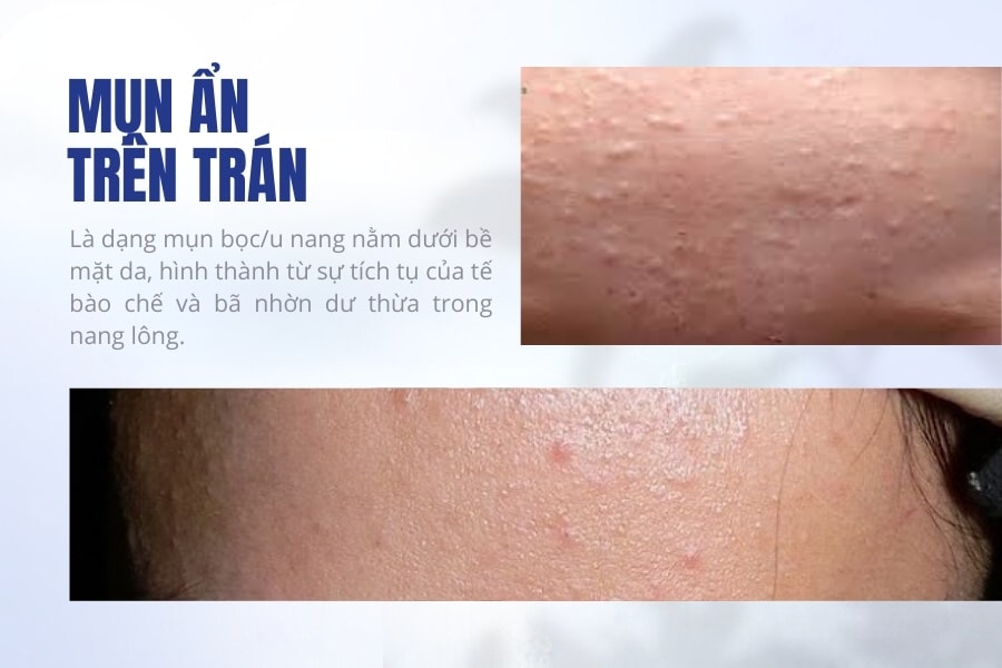 Bị nổi mụn ẩn trên trán là gì? Bị nổi mụn ẩn trên trán là gì?