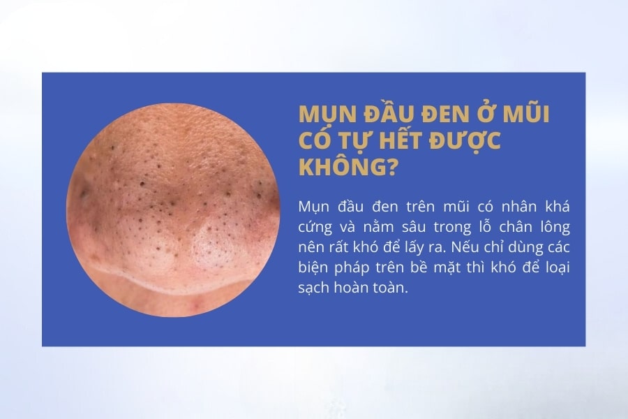 Mụn đầu đen ở mũi có tự hết được không?