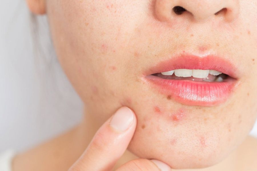 Sử dụng thuốc tránh thai có thể dẫn đến sự mất cân bằng hormone gây mụn đầu trắng Sử dụng thuốc tránh thai có thể dẫn đến sự mất cân bằng hormone gây mụn đầu trắng