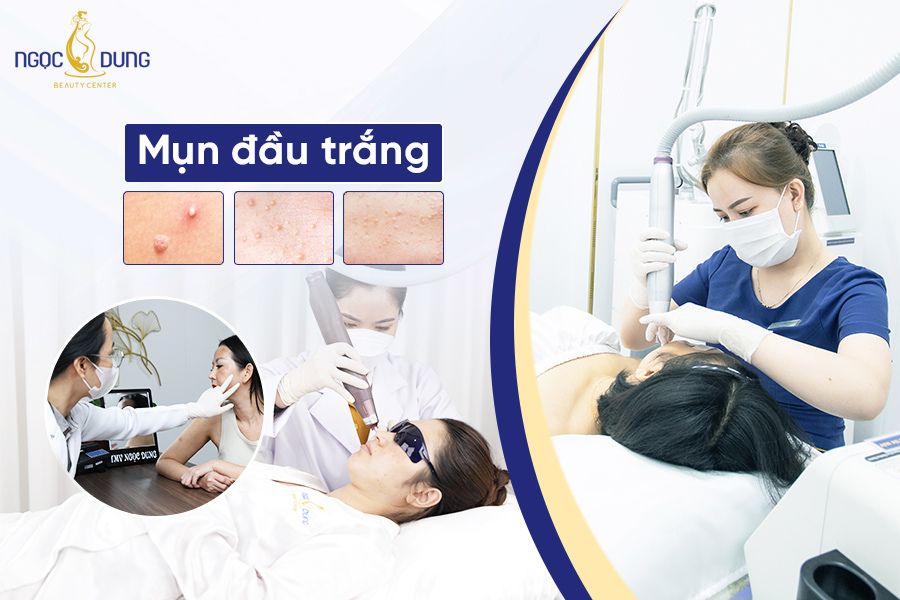 Mụn đầu trắng là gì? Mụn đầu trắng có tự hết không? Hãy cùng TMV Ngọc Dung tìm hiểu ngay