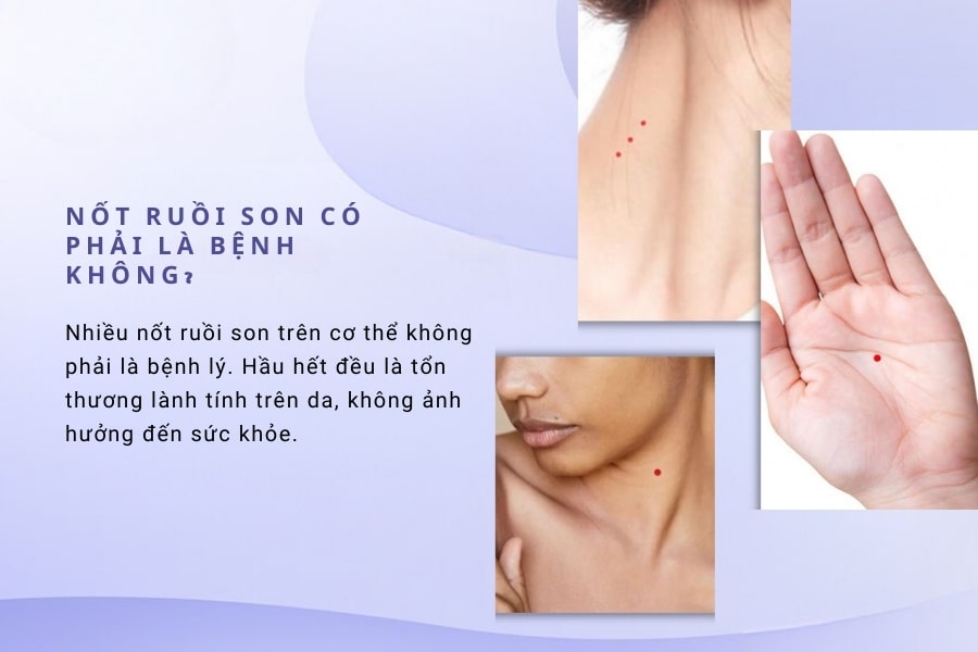 Nốt ruồi son có phải là bệnh không? Nốt ruồi son có phải là bệnh không?