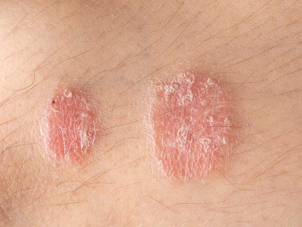 Nấm da có thể lây từ người sang người do sử dụng chung các vật dụng hàng ngày