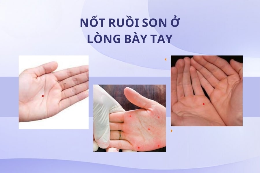 Xem tướng mụn ruồi son ở lòng bàn tay Xem tướng mụn ruồi son ở lòng bàn tay
