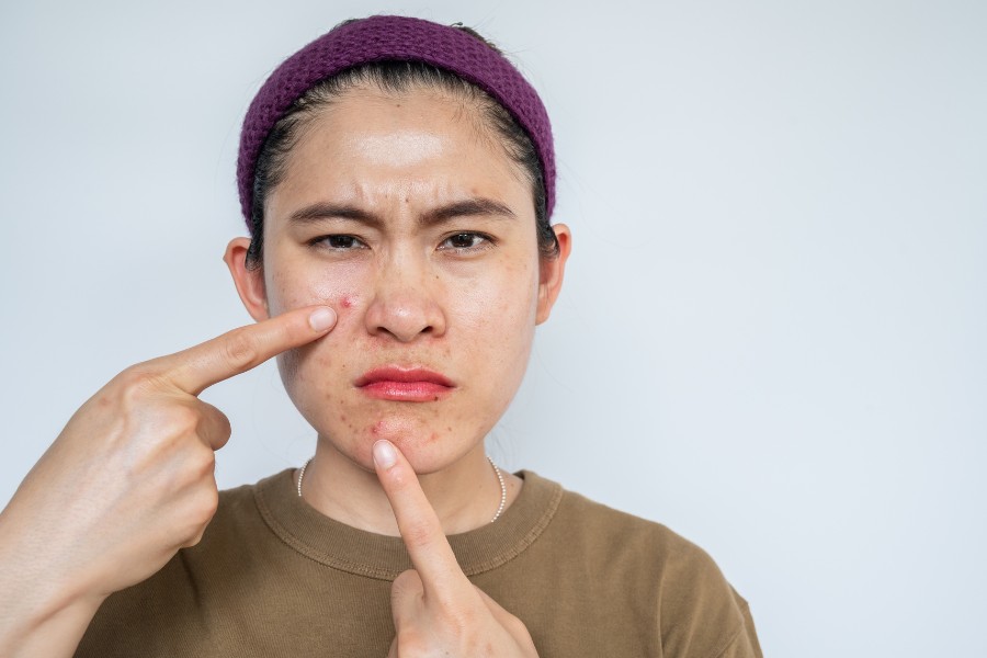 Vùng chữ T có tuyến dầu nhờn hoạt động mạnh mẽ hơn những vùng da khác Vùng chữ T có tuyến dầu nhờn hoạt động mạnh mẽ hơn những vùng da khác