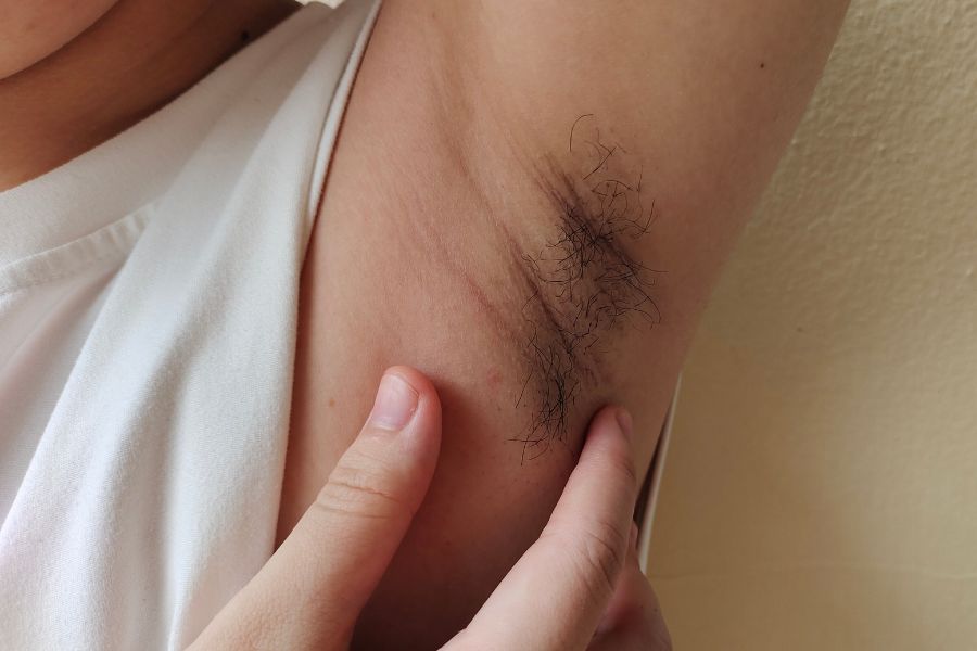 Da dưới cánh tay sần sùi, khô ráp do tình trạng lông mọc đôi ở nách