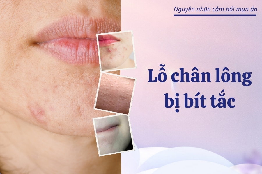 Tắc nghẽn nang lông là nguyên nhân gây mụn ẩn ở cằm Tắc nghẽn nang lông là nguyên nhân gây mụn ẩn ở cằm