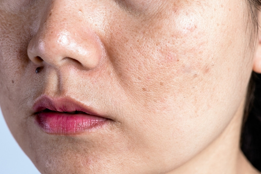 Tình trạng da bị sẹo rỗ sẹo thâm là hậu quả lăn kim sai kỹ thuật