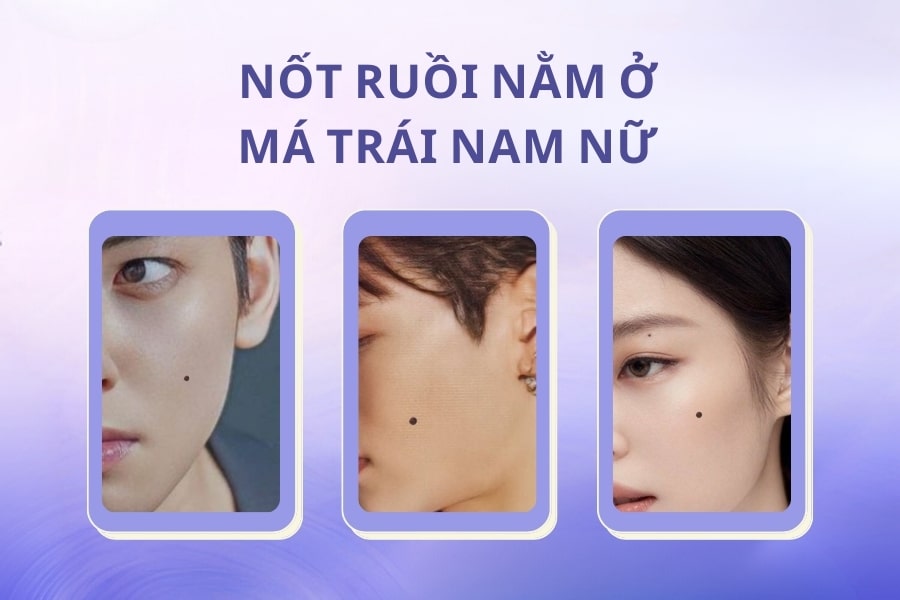 Nốt ruồi ở má trái nam Nốt ruồi ở má trái nam có ý nghĩa không may mắn