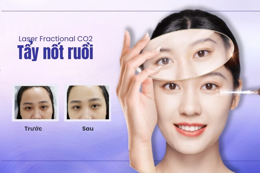 Giải mã ý nghĩa nốt ruồi trên mũi đàn ông và phụ nữ 11 Tẩy nốt ruồi ở mũi bằng laser Fractional CO2