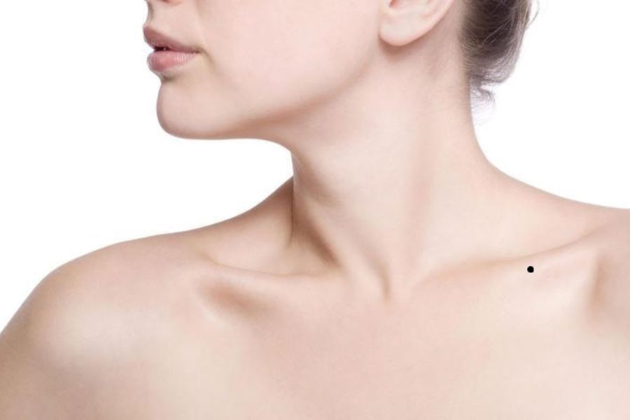 Nốt ruồi điền trạch ở vai