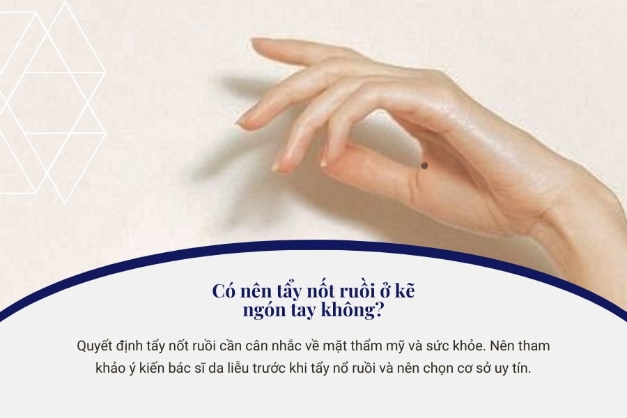 Có nên tẩy nốt ruồi ở kẽ ngón tay không?