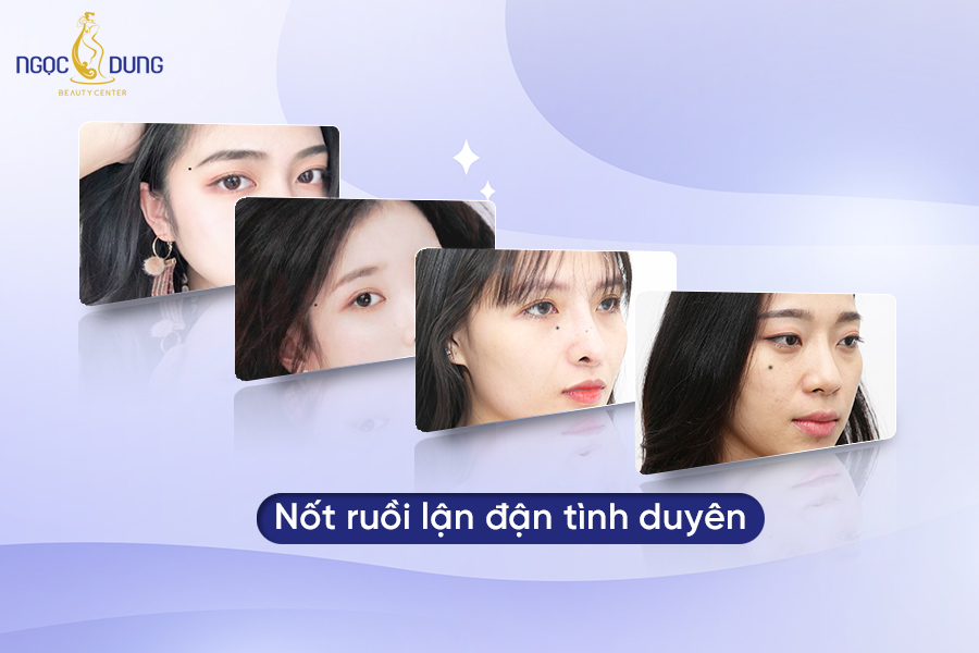 Top 10 nốt ruồi lận đận tình duyên nên xóa ngay để hạnh phúc
