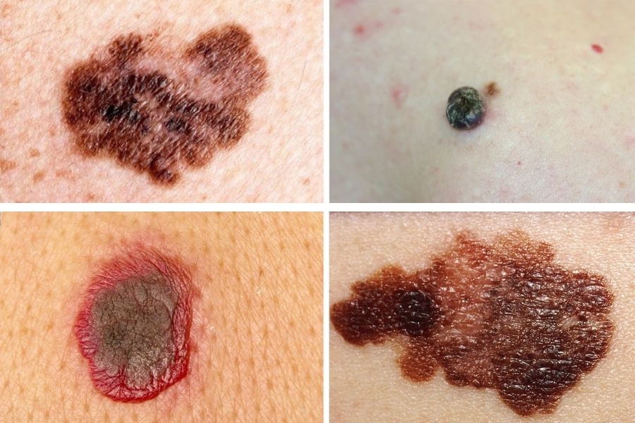 Nốt ruồi ác tính thường có màu sắc không đồng nhất và có đường kính trên 6mm