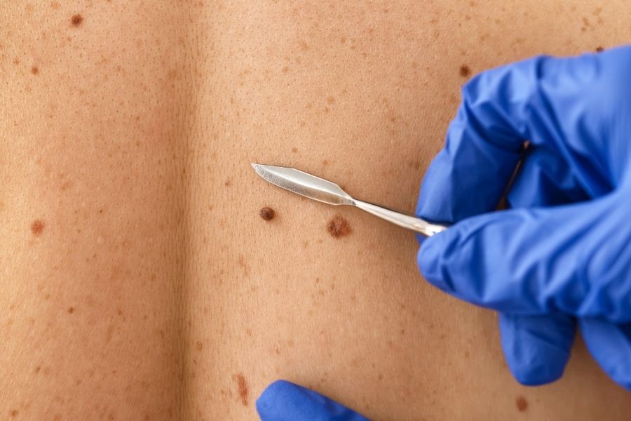 Nốt ruồi được hình thành do quá trình tích tụ của hắc tố melanin, và thường ở dạng lành tính