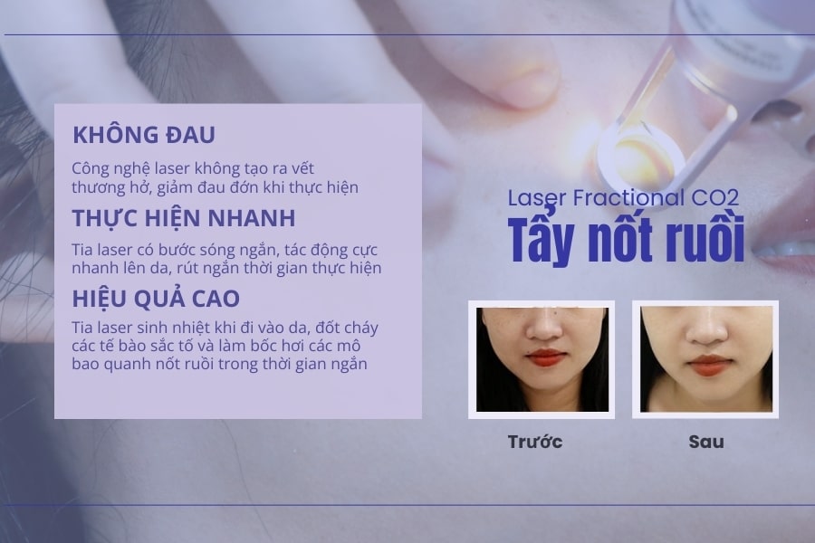 TMV Ngọc Dung - Địa chỉ tẩy nốt ruồi ở môi an toàn, không phá tướng TMV Ngọc Dung - Địa chỉ tẩy nốt ruồi ở môi an toàn, không phá tướng