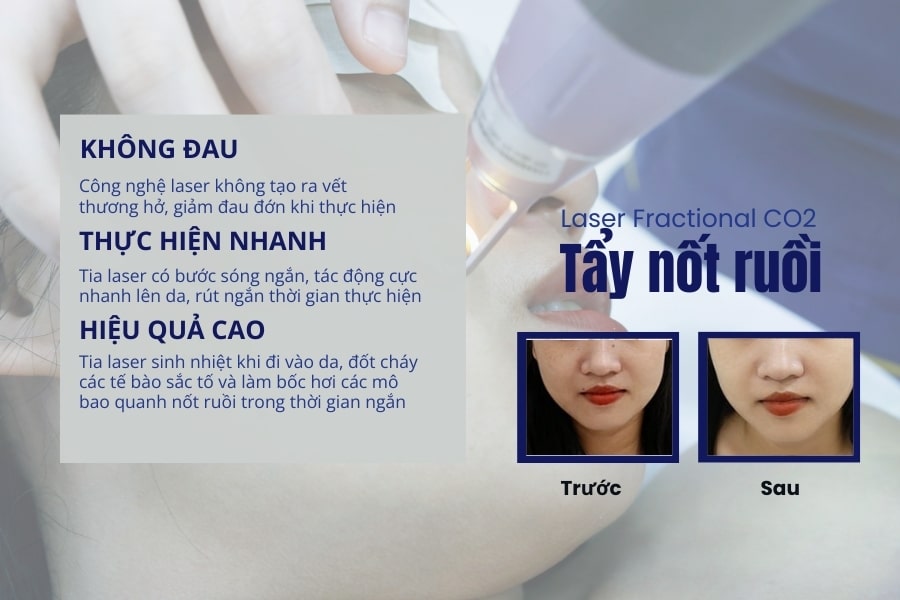 Ưu điểm của công nghệ laser CO2 Fractional tiên tiến