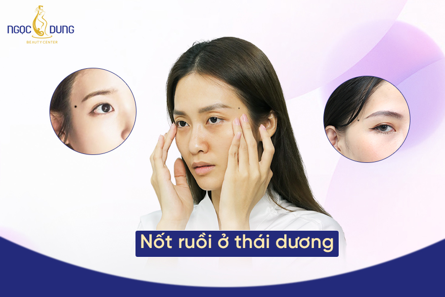 Nốt ruồi ở thái dương tốt hay xấu? Nên hay không nên xóa?