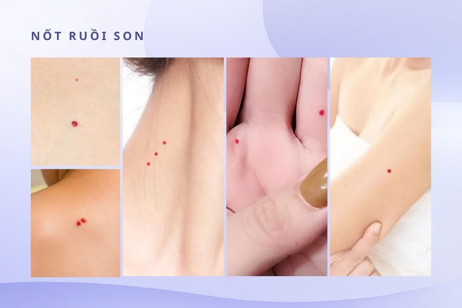Thế nào là nốt ruồi son? Thế nào là nốt ruồi son?