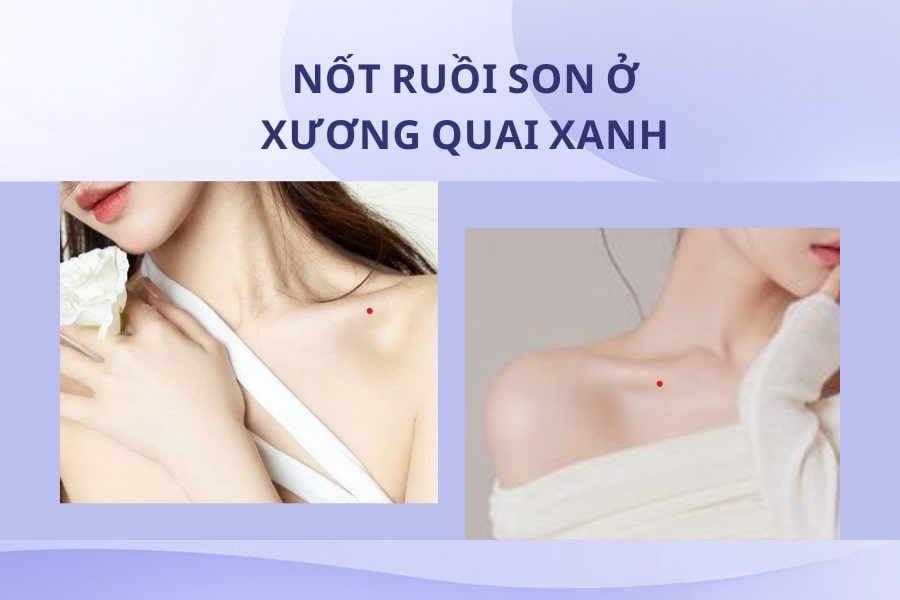 Mụn ruồi son ở xương quai xanh - Trái phải đều có người hậu thuẫn Mụn ruồi son ở xương quai xanh - Trái phải đều có người hậu thuẫn
