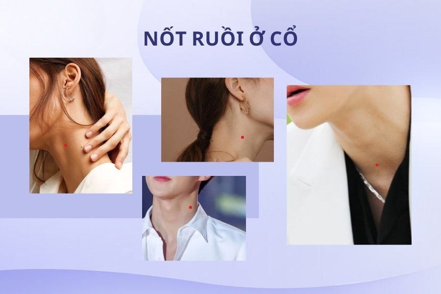 Mụn ruồi son ở cổ - Nốt ruồi tài lộc, giàu sang Mụn ruồi son ở cổ - Nốt ruồi tài lộc, giàu sang