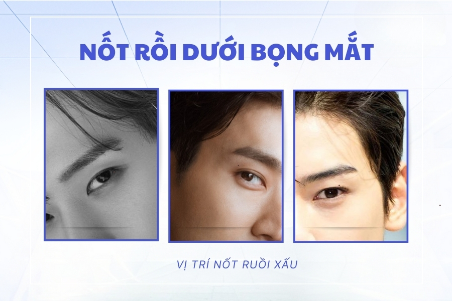 TOP 9 vị trí nốt ruồi xấu trên mặt đàn ông