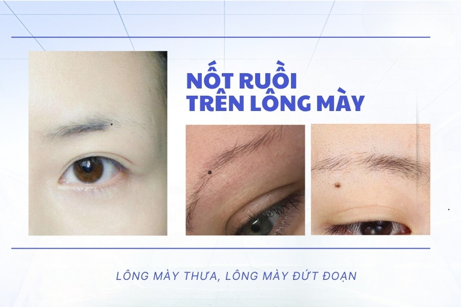 Nốt ruồi xấu trên mặt đàn ông thường nằm trên lông mày thưa, đứt đoạn
