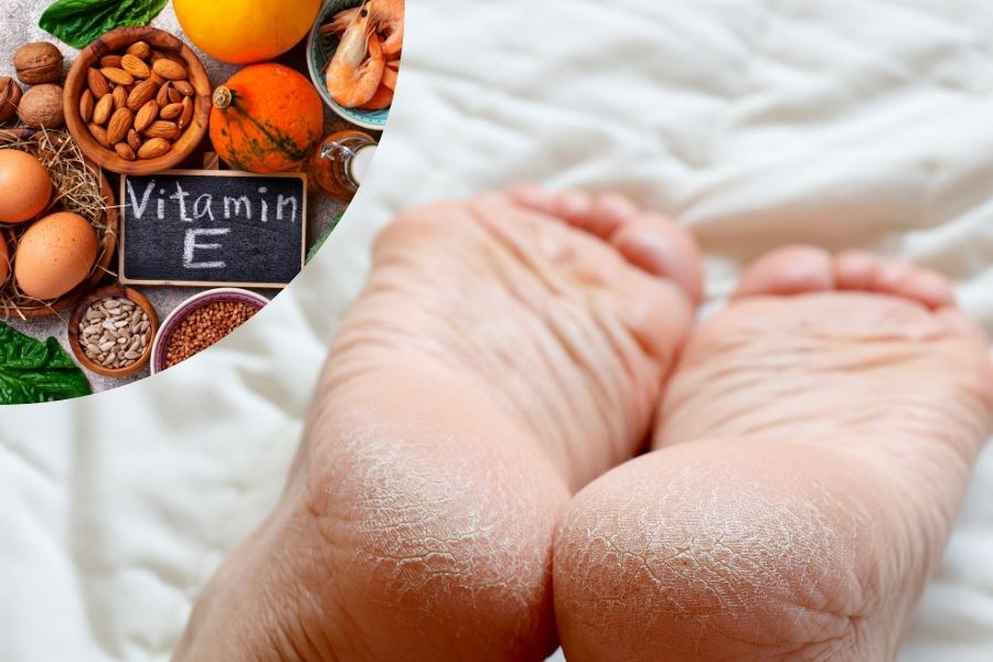Thiếu vitamin E có thể gây nứt gót chân, giảm thị lực và khiến làn da nhanh chóng lão hóa