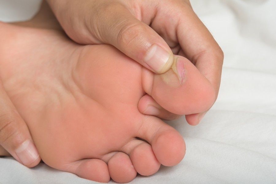 Cơ thể mất nước có thể khiến cho bàn chân bị khô ráp, bong tróc da Cơ thể mất nước có thể khiến cho bàn chân bị khô ráp, bong tróc da