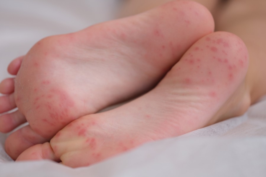 Nguyên nhân và cách trị rộp da lòng bàn chân tại nhà 3 rop da