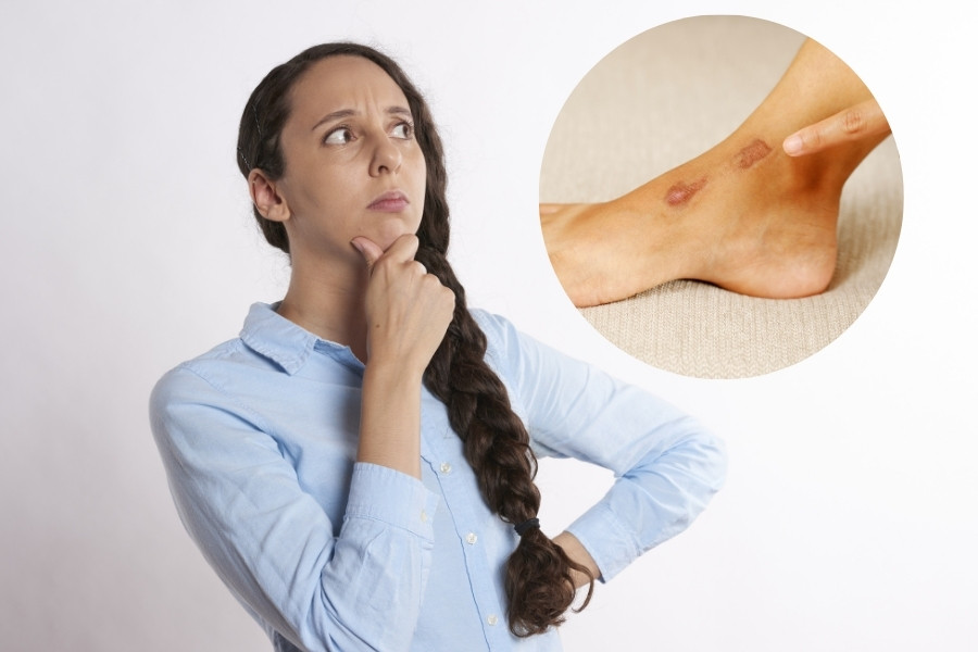 Việc xử lý vết thương đúng cách và can thiệp điều trị sẹo kịp thời có thể giúp làm mờ sẹo thâm hiệu quả