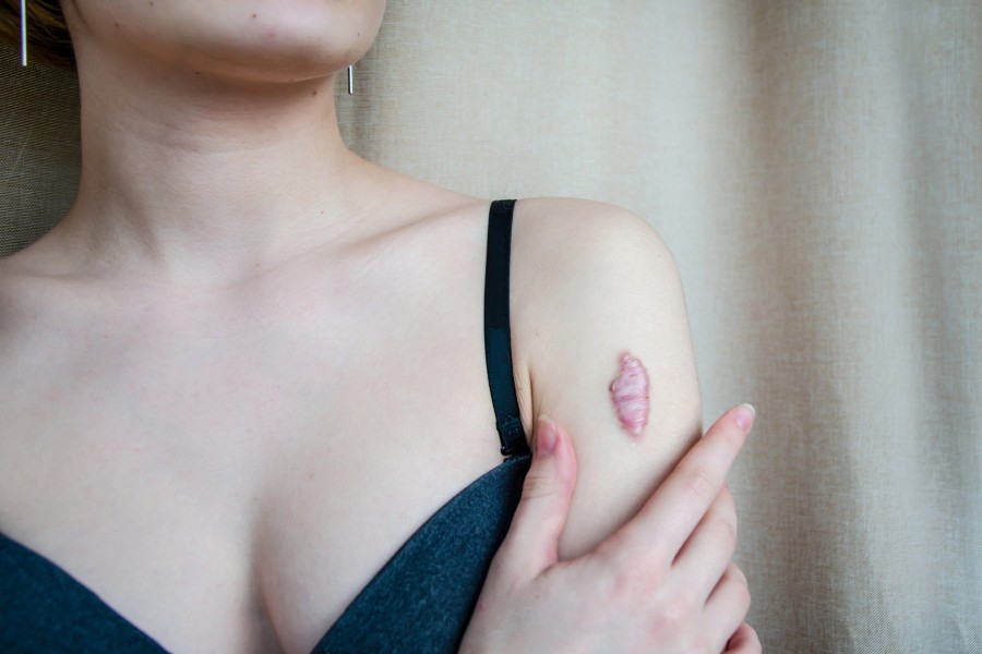 Tại sao sẹo lồi ngày càng to? Cách trị sẹo lồi lan rộng hiệu quả 2 width=