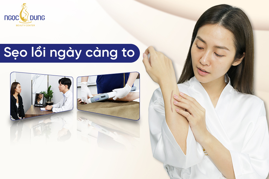 sẹo lồi ngày càng to