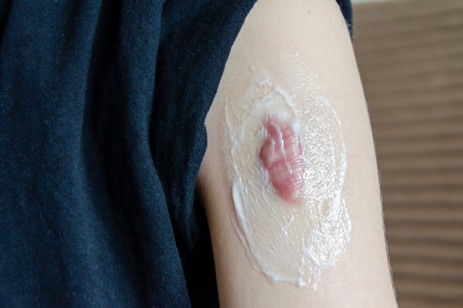 Sử dụng thuốc bôi thoa để ngăn ngừa tình trạng sẹo lồi ngày càng to Sử dụng thuốc bôi thoa để ngăn ngừa tình trạng sẹo lồi ngày càng to