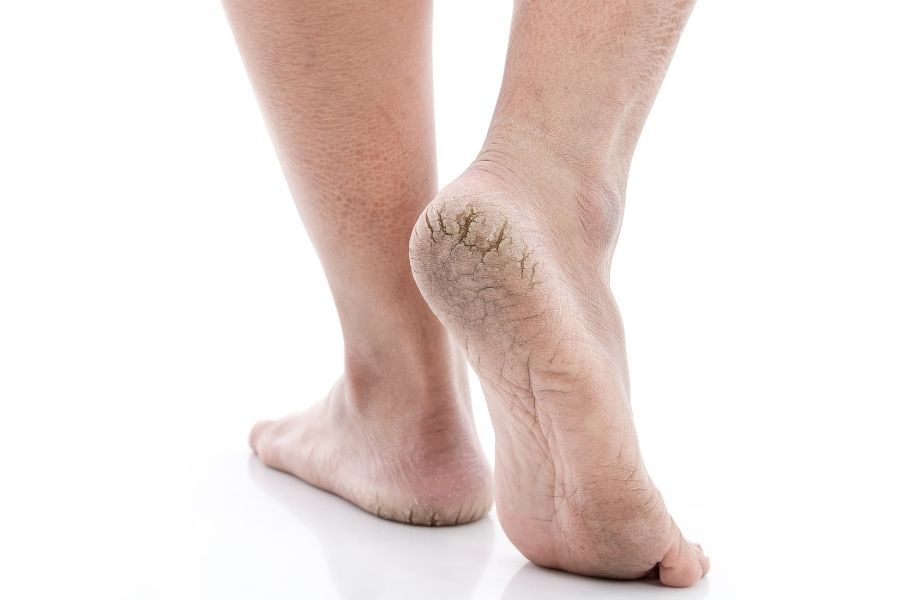 Nứt gót chân là gì? Nứt gót chân là hiện tượng các tế bào sừng không tự bong tróc mà kết dính và phát triển với nhau