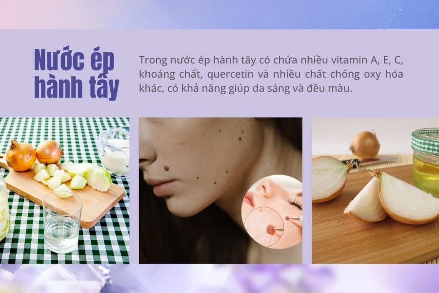 Cách tẩy nốt ruồi tại nhà nhanh nhất bằng nước ép hành tây