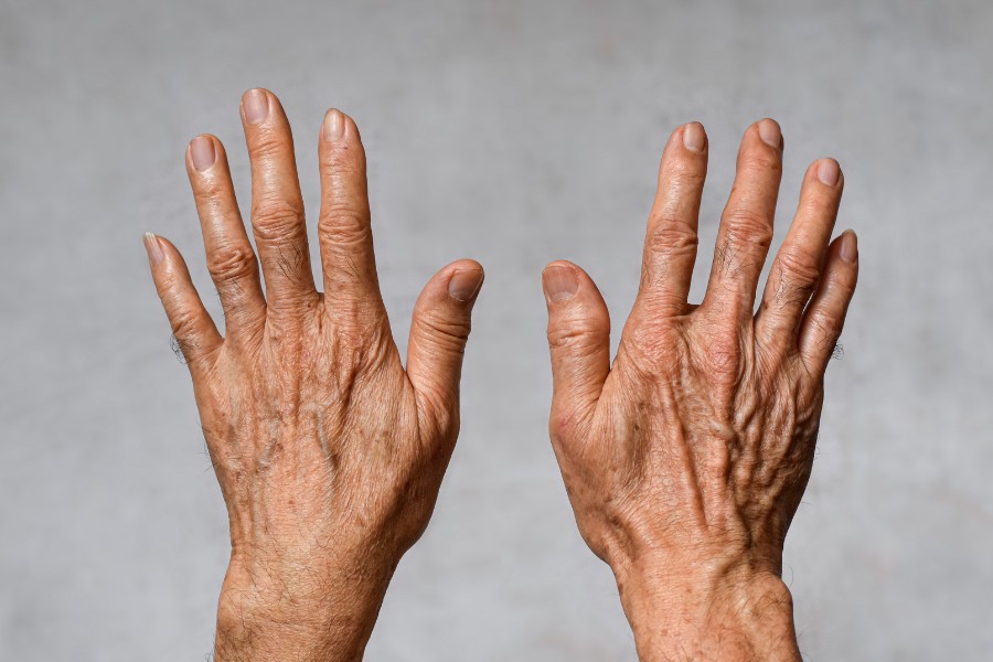 Sự xuất hiện vết thâm trên tay cũng có thể duy truyền qua nhiều thế hệ Vết thâm đen trên da tay do di truyền