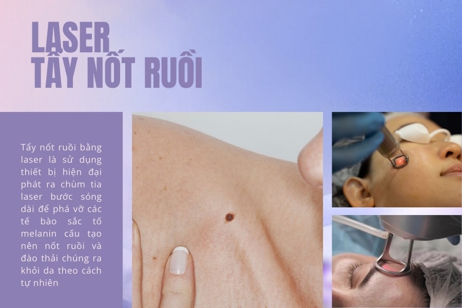Tẩy nốt ruồi bằng laser là gì?