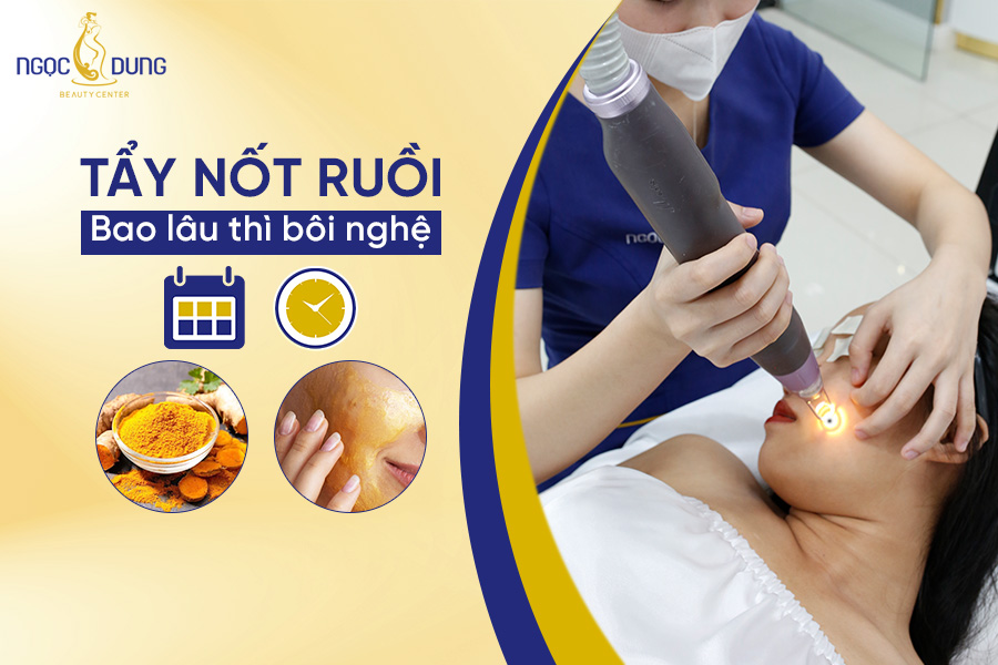 Tẩy nốt ruồi bao lâu thì bôi nghệ? Cách bôi nghệ hiệu quả