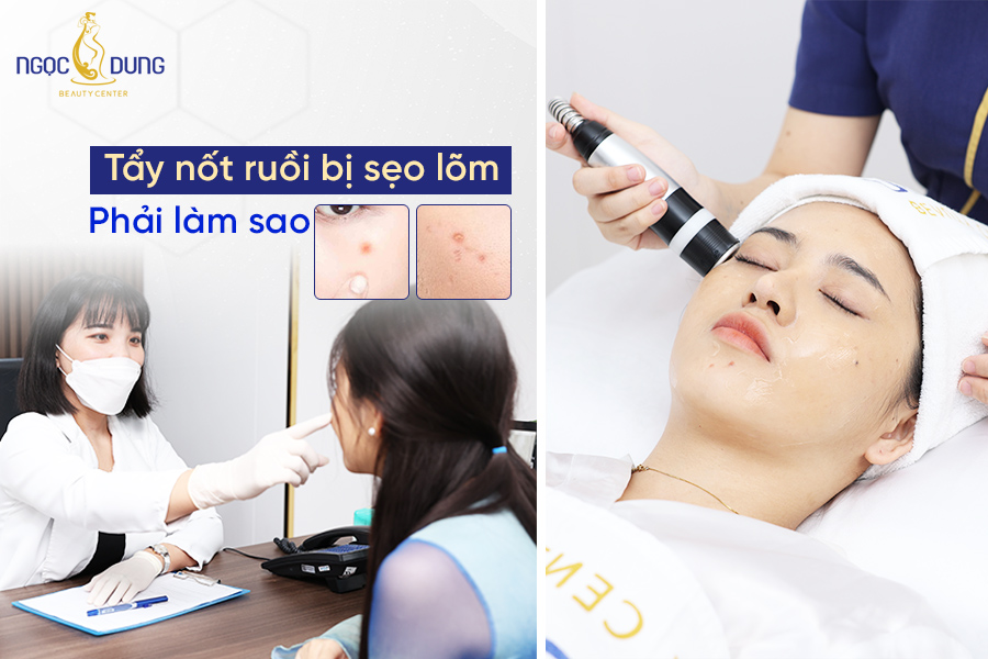 tẩy nốt ruồi bị sẹo lõm phải làm sao
