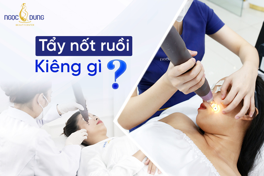 Tẩy nốt ruồi kiêng gì? Hãy cùng chuyên gia tại Thẩm mỹ viện Ngọc Dung giải đáp chi tiết