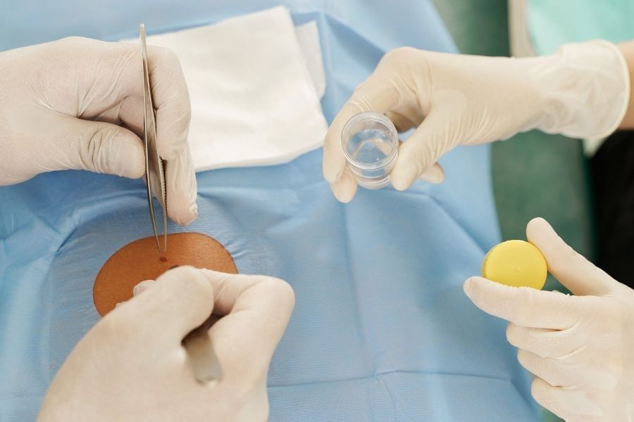 Thực hiện xóa nốt ruồi bằng phương pháp tiểu phẫu tại các cơ sở y tế uy tín