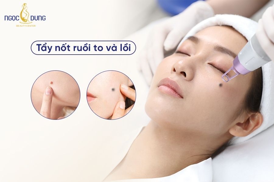 Tổng hợp các cách tẩy nốt ruồi to và lồi hiệu quả mà có thể bạn đang muốn biết