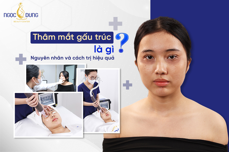thâm mắt gấu trúc