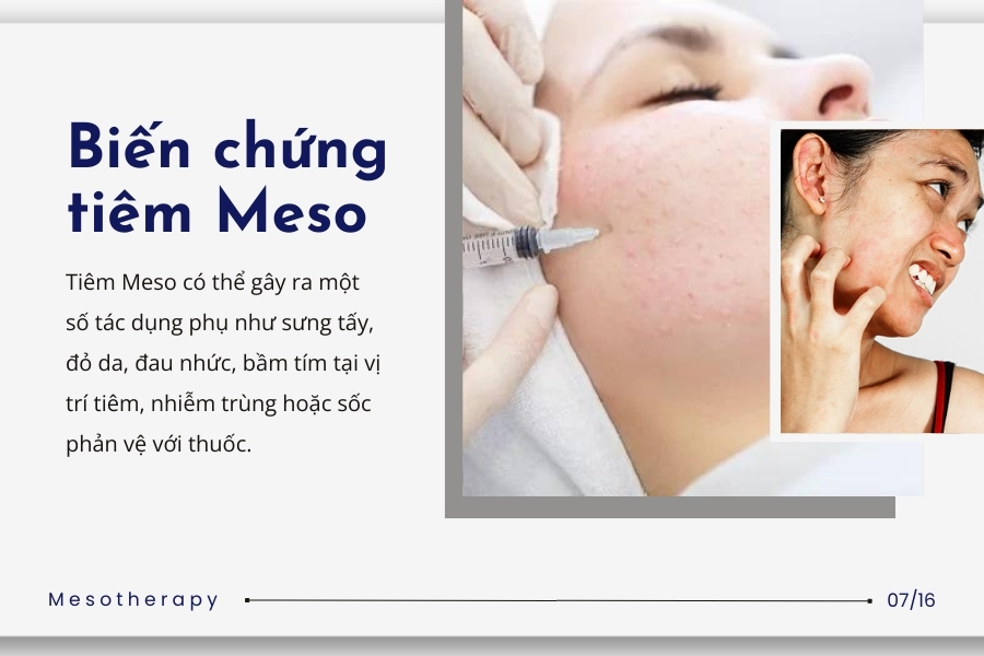 Các biến chứng, tác dụng phụ công nghệ Mesotherapy là gì? Các biến chứng, tác dụng phụ công nghệ Mesotherapy là gì?